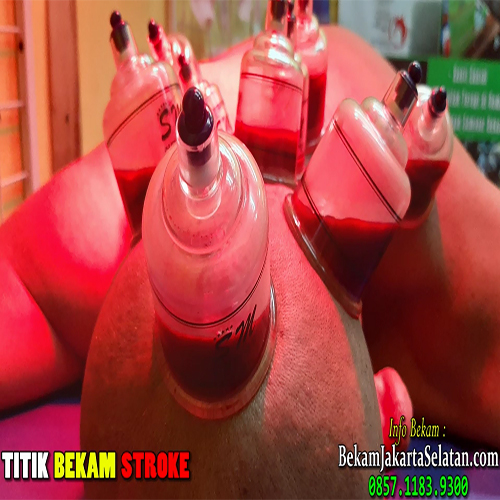Bekam Stroke